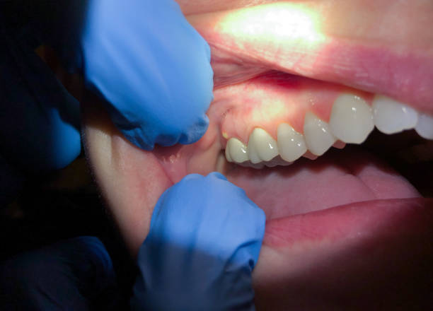 Best Emergency Root Canal Treatment in Gibson City, IL