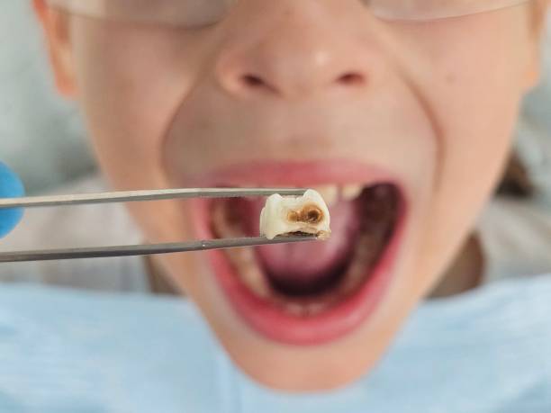Best Urgent Care for Lost Fillings or Crowns in Gibson City, IL